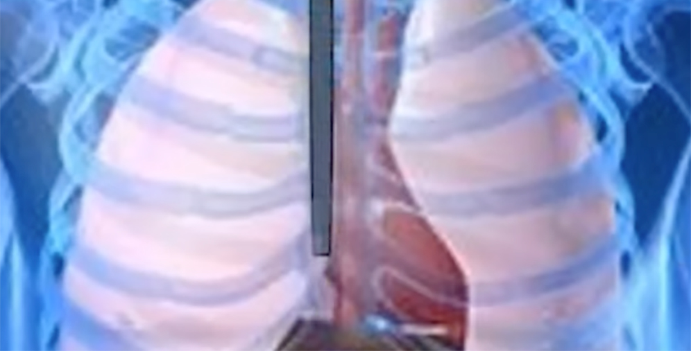 Chest X-ray showing lungs and a vertical rectangular marker along the center of the chest.