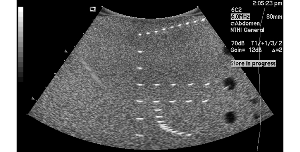 Grayscale abdominal ultrasound image with measurement markers and dotted curved guides overlaid; text readouts on right show settings and 'Store in progress'.
