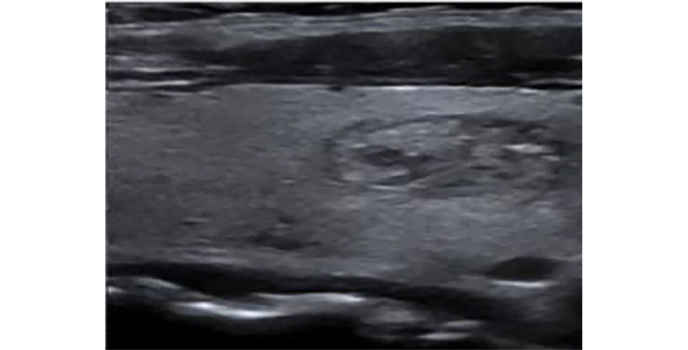 Compound Imaging ON