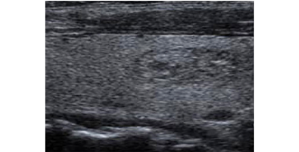 Compound Imaging OFF