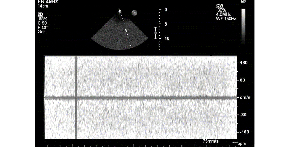 Constant static in CW Doppler mode